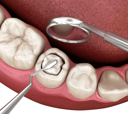 Oral hygiene 3d image of filling a cavity